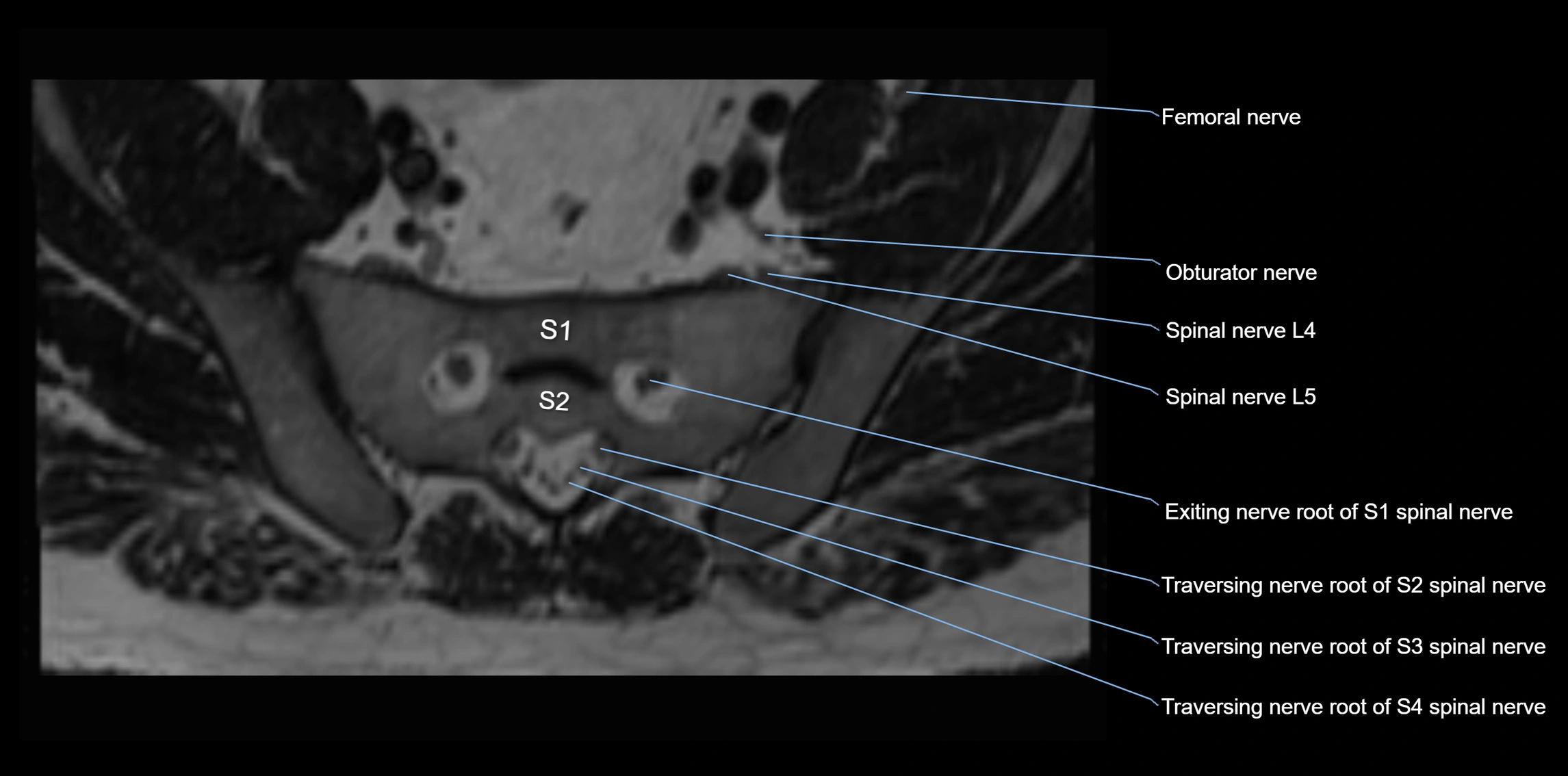 MR lumbosacral plexus axial cross sectional anatomy 3T  radiology  image-img-1008001-00078.webp